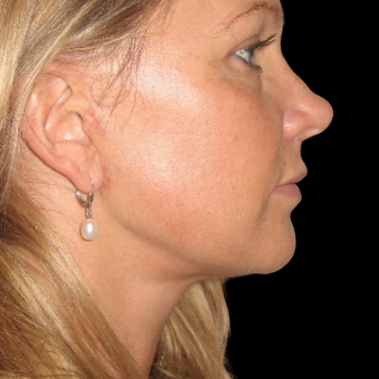 after-deep-plane-facelift